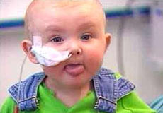 Ребенок с тяжелым комбинированным иммунодефицитом, фото BBC